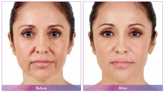 Dermal fillers before and after